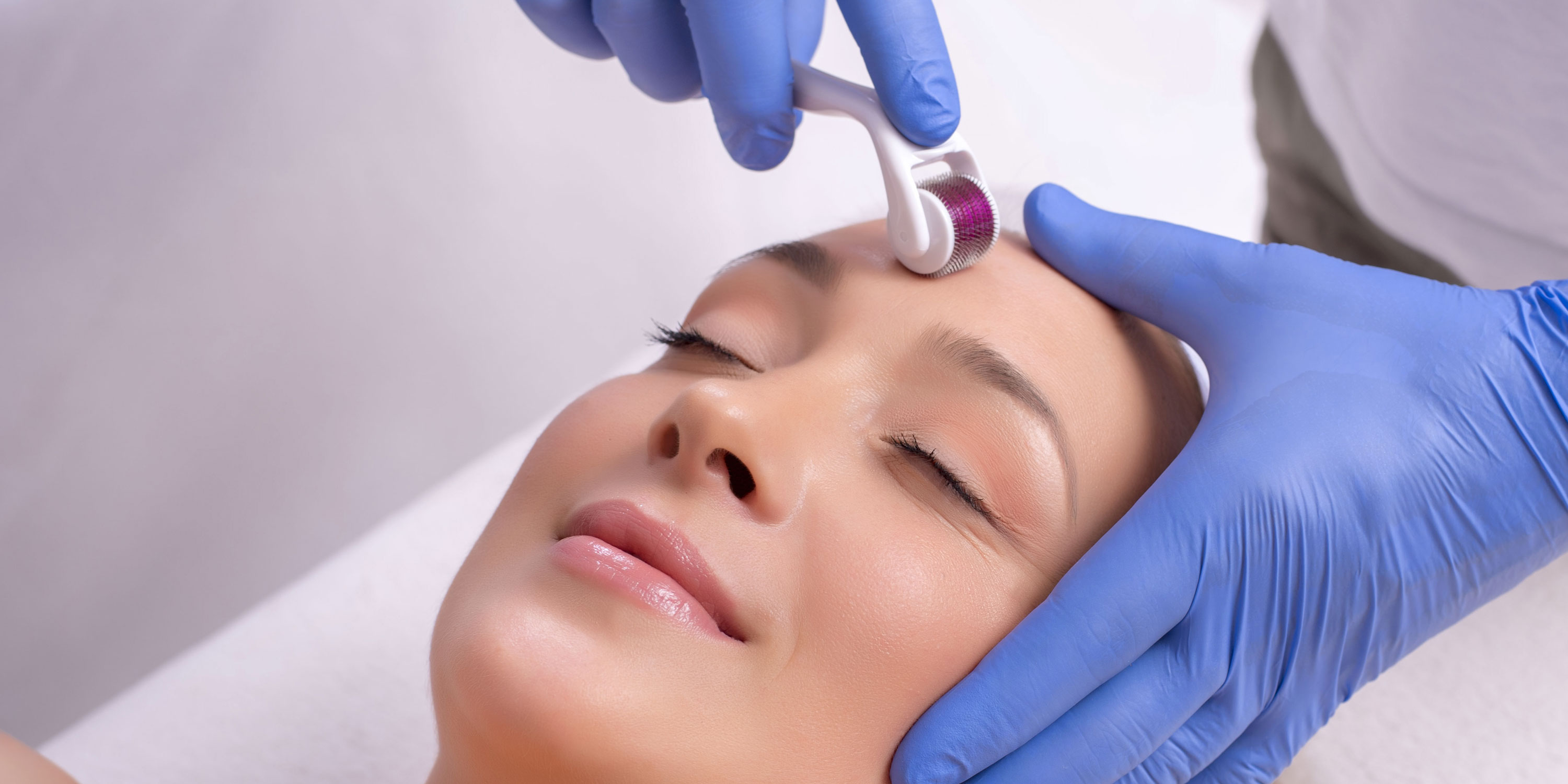 Microneedling