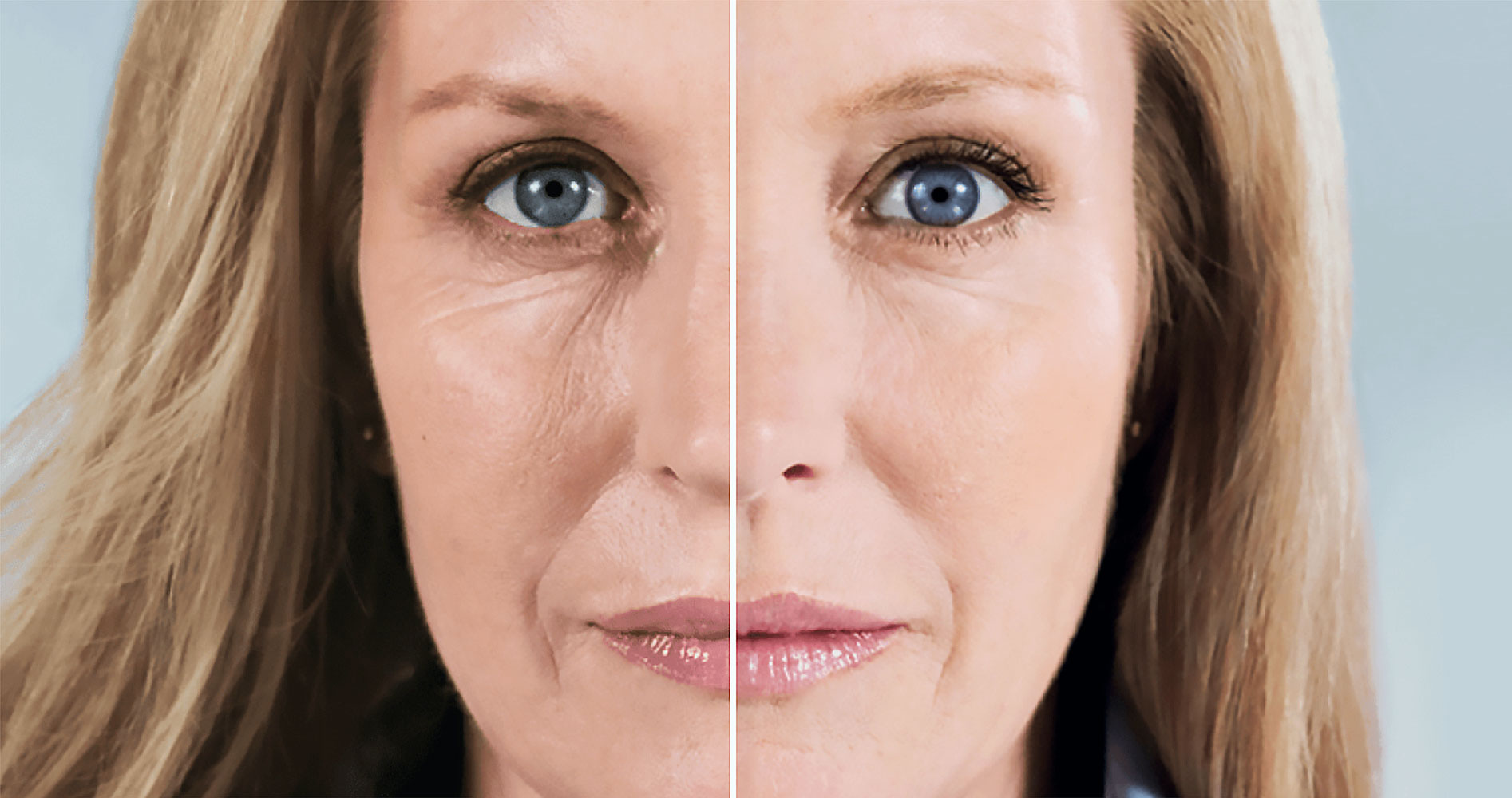 Liquid Lifting mit Sculptra®